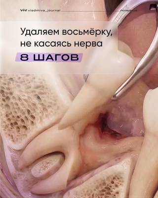 Удаление зуба мудрости: распил на две части.